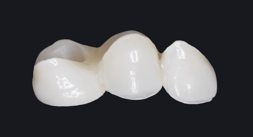 歯冠部は審美性と強度を備えた ジルコニアセラミック